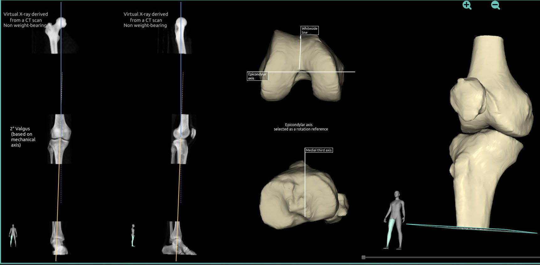 FollowKnee mechanical knees