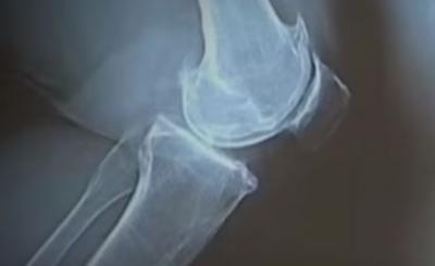 KNEE-followknee-reseauCHU-LATIM